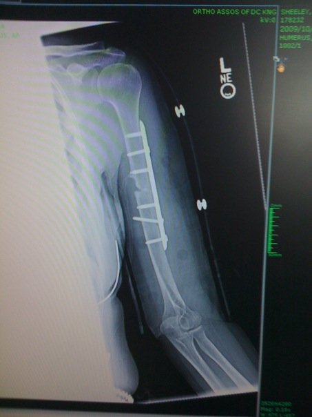 broke arm