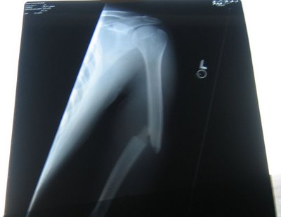 broken left humerus